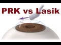 PRK VS Lasik #Hindi