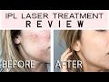 IPL LASER TREATMENT Reivew