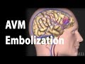 Arteriovenous malformation (AVM) and Embolization Treatment, Animation.