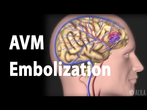 Video: Embolisasi Endovaskular: Tujuan, Prosedur, Dan Risiko