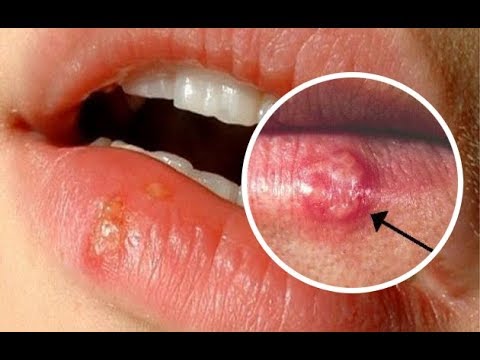 فيديو: 3 طرق لعلاج القروح الباردة داخل فمك