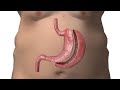 Minha batalha contra o meu peso - A cirurgia Bariatrica é uma opção?