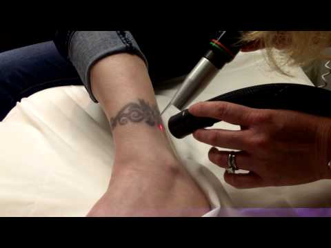 Things to Note Before Visiting the Best Tattoo Removal Clinic in Faridabad