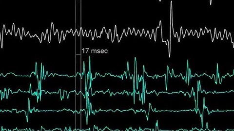 Reducing Noise Levels in Electrophysiology Medical Procedures