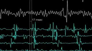 Reducing Noise Levels In Electrophysiology Medical Procedures