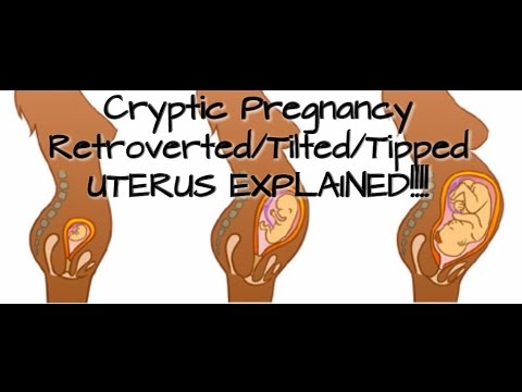 Cryptic Pregnancy--Retroverted/Tilted/Tipped Uterus ...