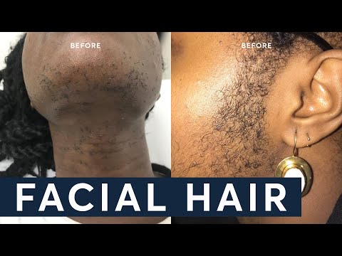 How to remove Facial Hair - The TRUTH about Laser Hair Removal