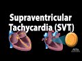 Supraventricular Tachycardia (SVT), Animation