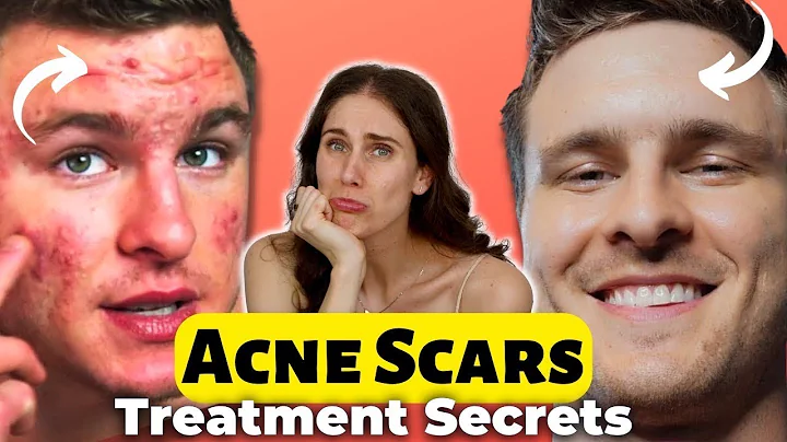 1 Thing That Cleared His Severe Cystic Acne Scarri...