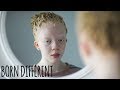I’m Black, Even With Albinism | BORN DIFFERENT