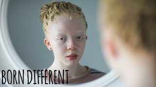 I’m Black, Even With Albinism | BORN DIFFERENT