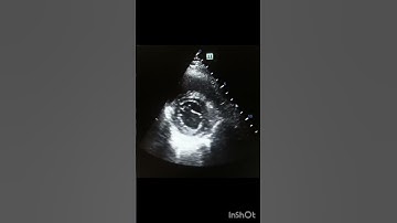 #echocardiography #parasternal short axis#mitral valve level