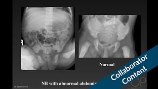 Abdominal Radiographic Diagnosis in the Newborn by G. Taylor | OPENPediatrics