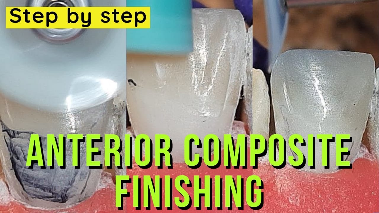 finishing anterior composite step by step