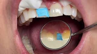 Houston Cosmetic Dentist...reversible Cosmetic Bonding...no More Front Tooth Gap