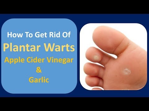 how-to-get-rid-of-plantar-warts-|-apple-cider-vinegar.&garlic