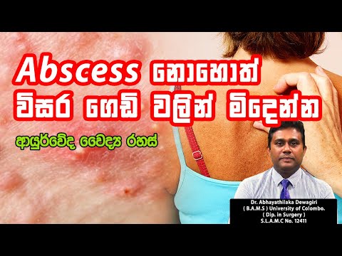 Abscess  |  විසර ගෙඩි රෝගයට නොවරදින ආර්යුවේද පිළියම්  | Dr. Abhayathilaka Dewagiri