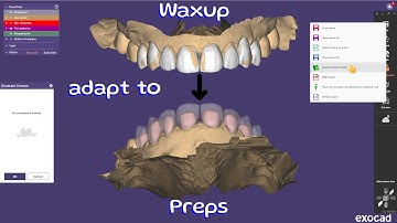 Exocad Waxup to Prep Workflow | How to Export Tooth Models for Same-Day Adapt to Prep Cases
