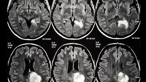 Brain Tumor Classification using Convolution Neural Network Tensorflow|+91-8283834812 for query