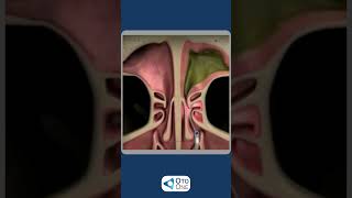 Sofre com sinusites frequentes? A sinusoplastia por balão é uma técnica moderna, menos invasiva!
