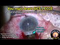 Cataractcoach 1079 learning sics  ecce manual cataract extraction