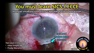 CataractCoach 1079: learning SICS / ECCE manual cataract extraction screenshot 4