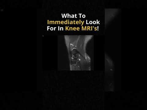 What To Immediately Look For On Knee MRIs 