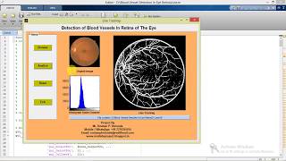 Detection of Blood Vessels in Retina of the Eye Matlab Project with Source Code