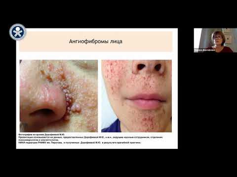 Туберозный склероз. Диагностика и лечение. Дорофеева М.Ю.