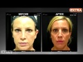Thermismooth for Eye Wrinkles on Extra TV