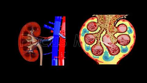 Chronic Kidney Diseases - Animated Atlas