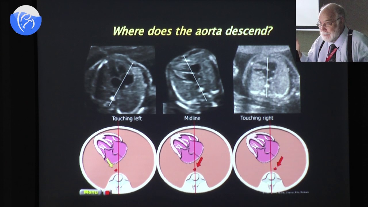 Detailed Fetal Cardiovascular Ultrasound Anatomy And Cardiac Views Prof Detailed fetal cardiovascular ultrasound anatomy and cardiac views prof