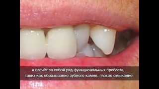 Одни зубы сзади других Одни зубы сзади других