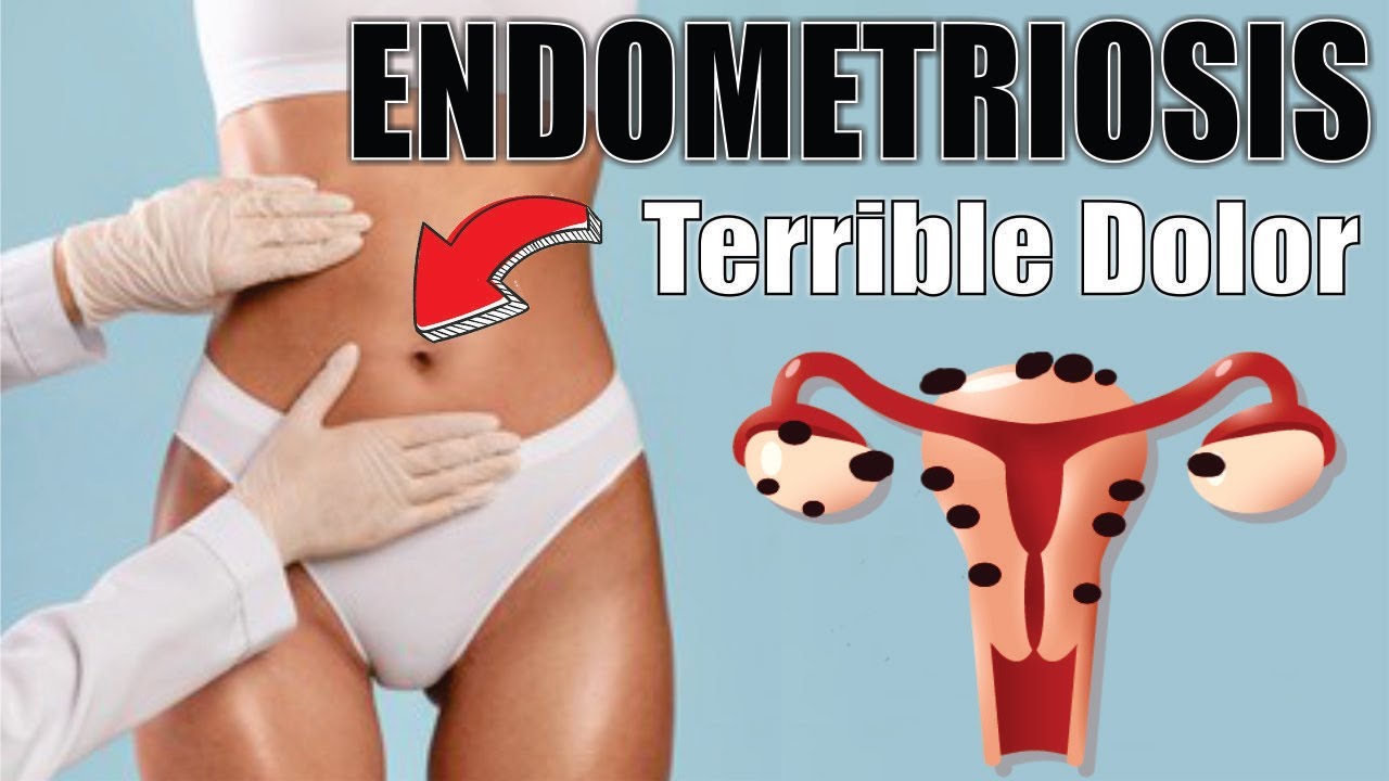 Endometriosis dolor después de la regla