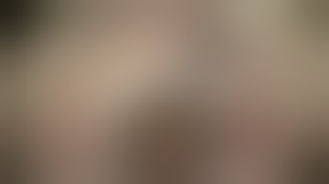 IOL exchange/Goretex  sutured CZ70BD by Steven G.Safran MD