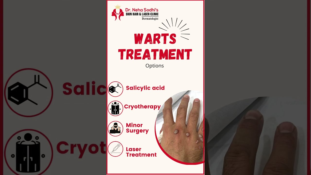 WARTS Treatment