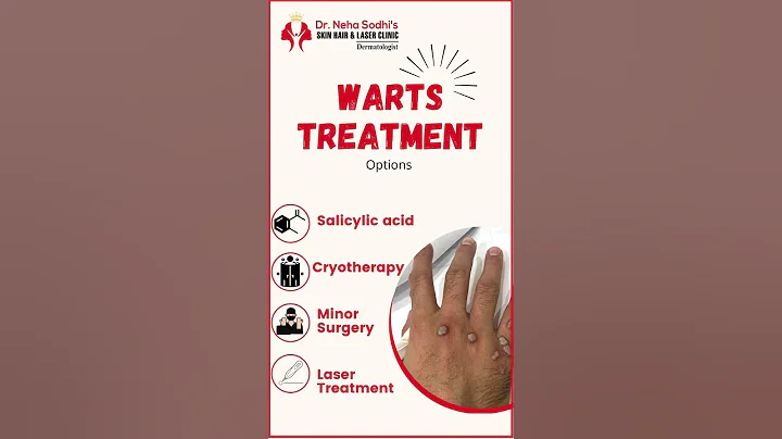 WARTS  Treatment