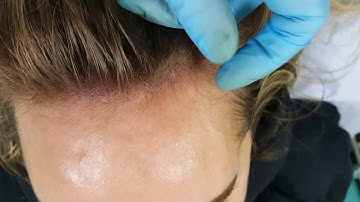 Female Hairline Scalp Micropigmentation Density by El Truchan @ Perfect Definition