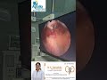 stones in the prostate 🫨❌️#femaleurologist #prostatehealth #prostatetreatment