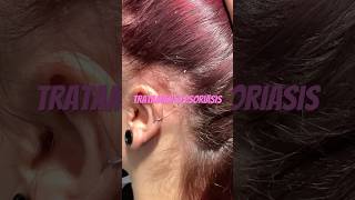 PSORIASIS CUERO CABELLUDO TRATAMIENTO CON BARROS DE AMLA #cabello #asturias #oviedo #psoriasis