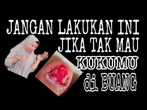 Hari ke 3 mengganti perban luka jempol kaki pasca bedah. 