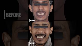 Life Changing Smile Transformation | Dental Braces | Clear Aligner- #dentist #dental #dentistry