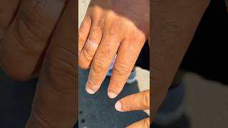 Fingers swell so quickly 😩