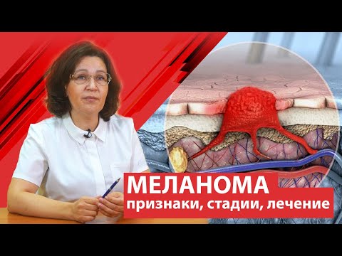 Меланома ( рак кожи ) . Признаки, стадии, лечение.