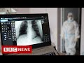 Some long Covid patients may have hidden damage to their lungs - BBC News - BBC News