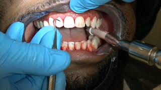 فیلم آموزشی انواع روش های جرم گیری دندان tooth scaling