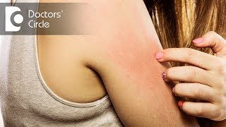 5 Top Causes of Itchy skin? - Dr. Urmila Nischal Resimi