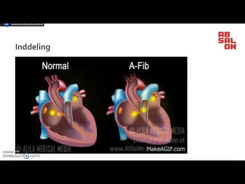 Video: Atrieflimren - Symptomer, Behandling, Diæt, årsager, Tegn