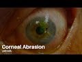 Eye injuries: Corneal abrasion