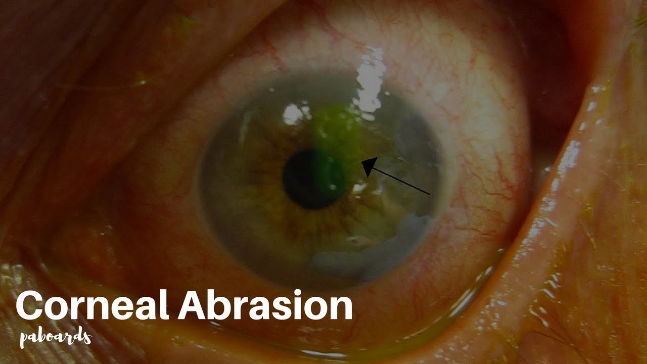 eye injuries corneal abrasion youtube